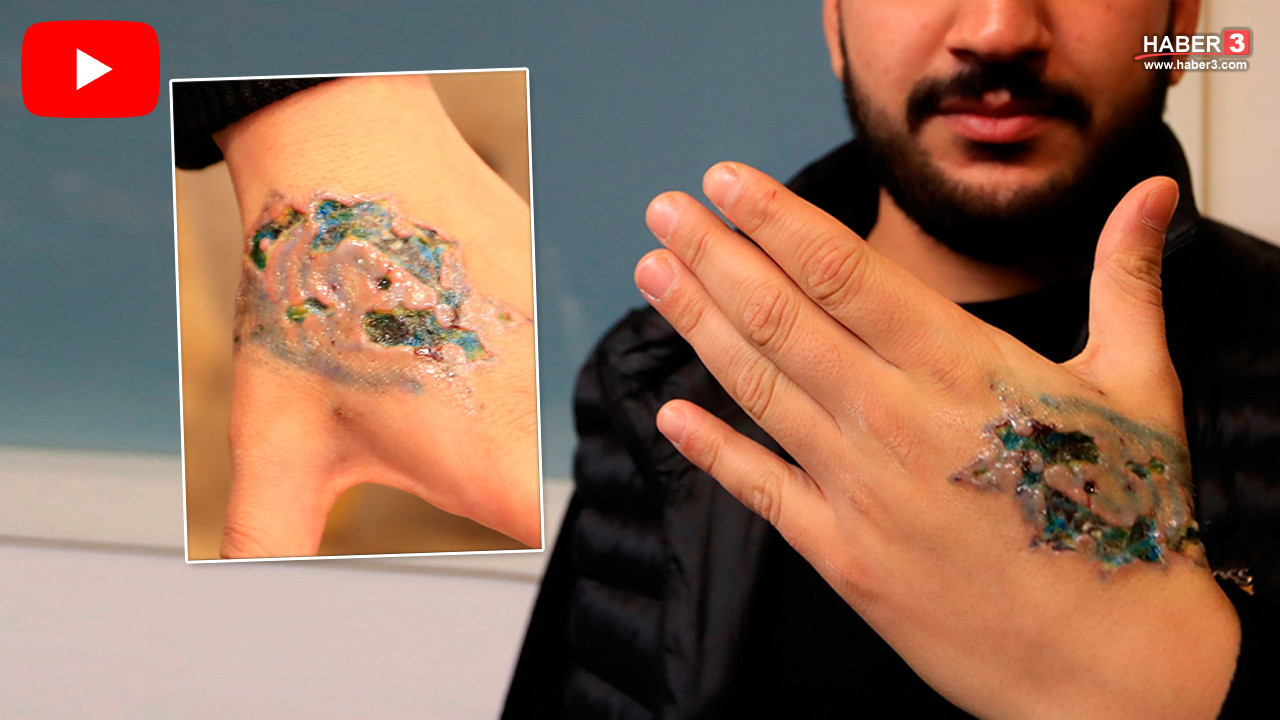 Yıllar önce yaptırdığı dövmeyi sildirmek isterken, kabusu yaşadı