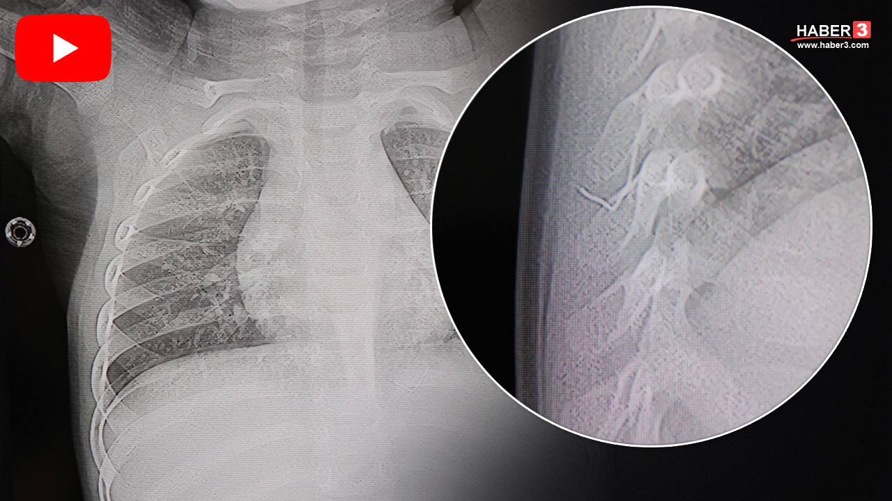 Bir yaşındaki minik bebeğin akciğerinden çıkan cisim şok etkisi yarattı