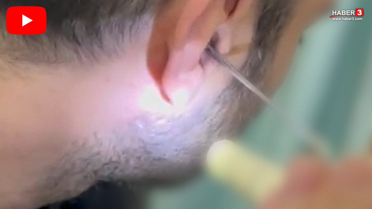 Uyuşturucuyu kulağının içine saklayan şüpheli cımbızla yakalandı!