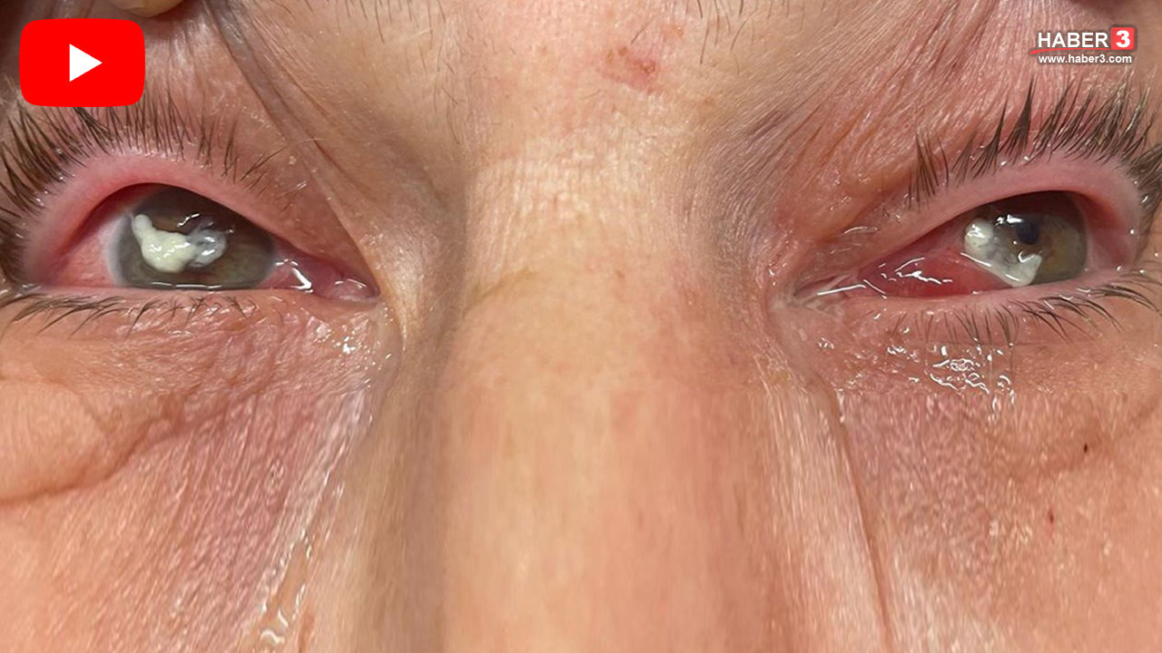 Gözlükten kurtulmak isterken gözlerinizden olabilirsiniz; bir hasta son anda kurtarıldı!