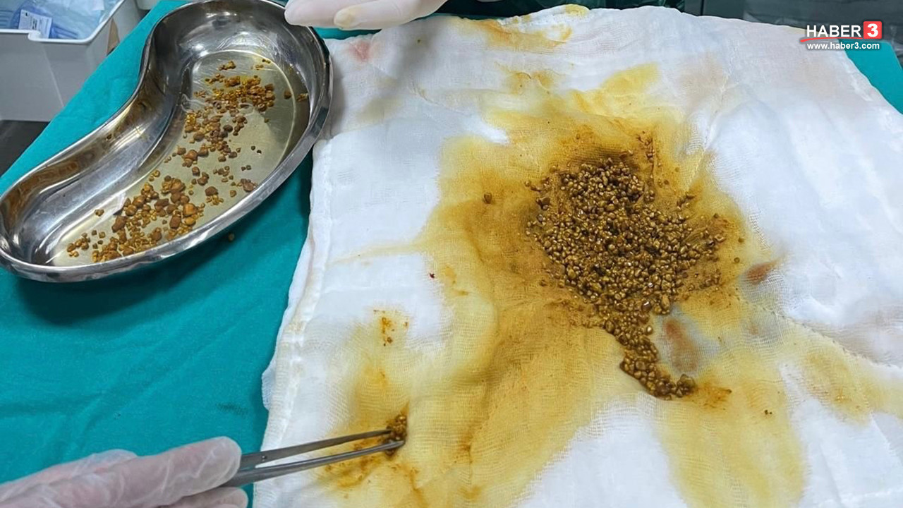 Şiddetli karın ağrısı şikayeti vardı... Doktorlar bile gözlerine inanamadı!