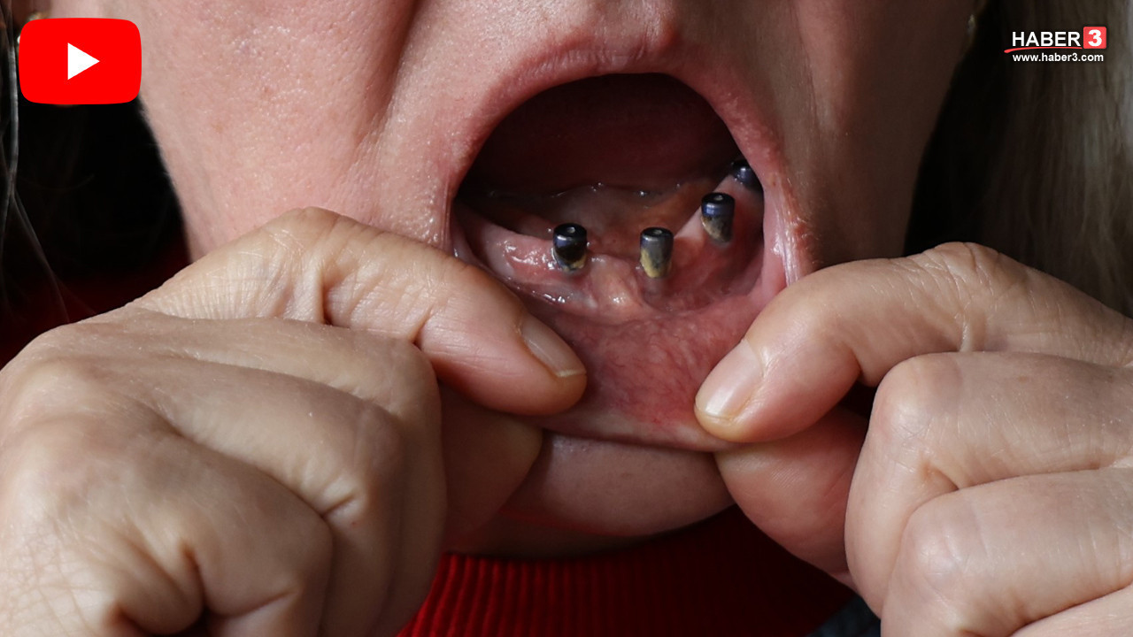 Diş ağrısıyla gitti, 25 dişini birden çektiler! İmplant tuzağında hayatı karardı!
