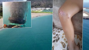 Antalya'da deniz enfeksiyonu alarmı: Denize giren çocuğun vücudu lekelerle kaplandı!