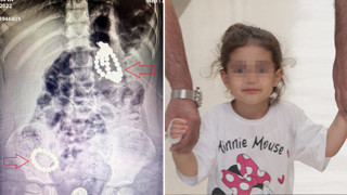 Minik Berfin'in karnından çıkanlar doktorları bile şoke etti