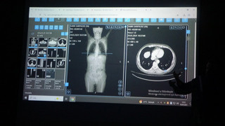 Türk bilim insanlarının yapay zeka ile kanser tedavisi planlaması ilk testi geçti!