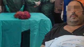 Vücudundan çıkarılan böbreğinin boyutu doktorları da şoke etti!