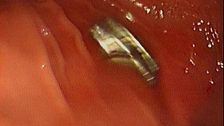 Üç yaşındaki yaramazın boğazından çıkanlar doktorları şoke etti