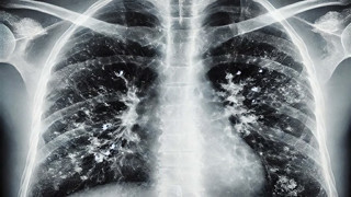 Grip ya da nezle olduğunuzu sanıyorsanız yanılıyorsunuz! Türkiye'de vaka sayıları artıyor...