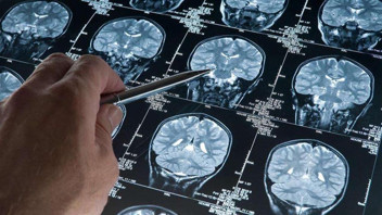 Alzheimer hastalığı için çığır açacak buluş