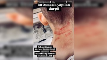 Rehabilitasyon merkezinde 5 yaşındaki çocuğa darp skandalı