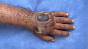 Tıp literatürüne girecek olay! Hırsız elini ısırdı, az kalsın kolunu kaybediyordu