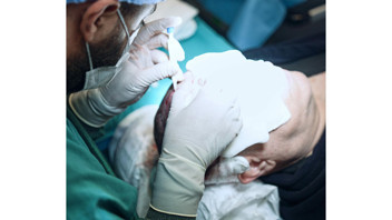 Saç Ekiminde Greft Sayısı Neden Önemlidir?