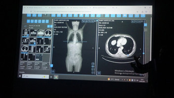 Türk bilim insanlarının yapay zeka ile kanser tedavisi planlaması ilk testi geçti!