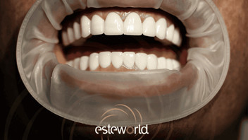 Klinik Tipi Diş Beyazlatma Rehberi