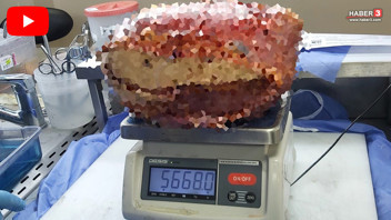 Bacağı git gide şişmeye başlayan hastanın vücudundan çıkan 5,6 kiloluk kitle şoke etti!