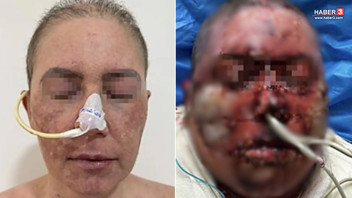 Kullandığı ilaç kabusu oldu! Talihsiz kadın tanınmaz hale geldi
