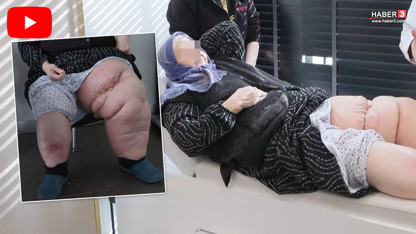 Fil hastalığına yakalanan yaşlı kadın sadece 2 haftada ayağa kalkmayı başardı