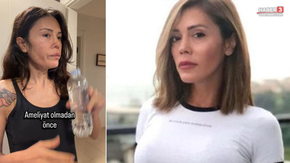 Yüz nakli olan eski Survivor yarışmacısı son halini paylaştı: ''Bebeksiliğim yapay zeka değil''