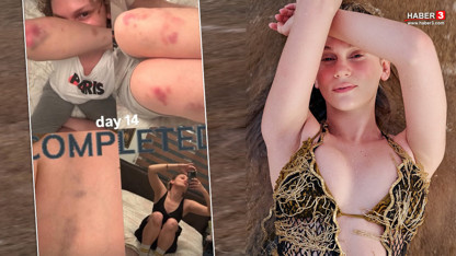 Farah Zeynep Abdullah’tan korkutan paylaşım! Vücudundaki morlukları görenler şoke oldu