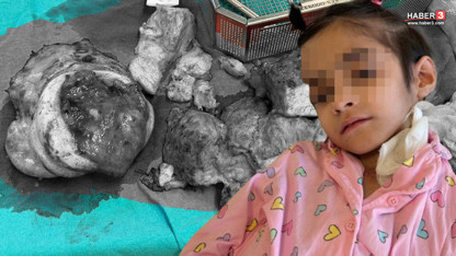 8 yaşındaki Fatma Dünya tıp literatürüne girdi! Boynundan çıkan kitle doktorları da şoke etti