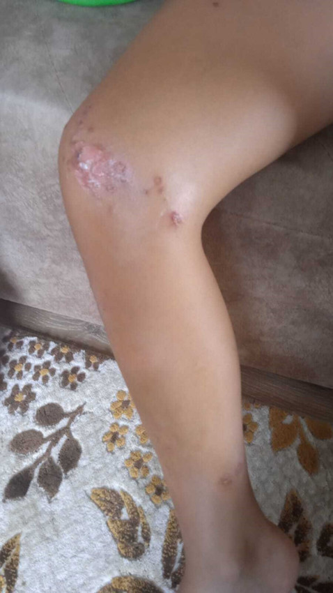 Antalya'da deniz enfeksiyonu alarmı: Denize giren çocuğun vücudu lekelerle kaplandı - Resim: 3