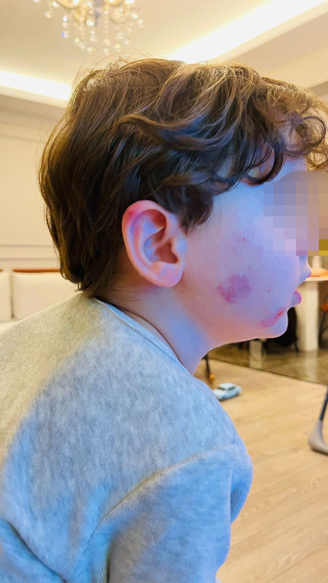 Kreşte skandal: 2,5 yaşındaki çocuk darp edilmiş halde bulundu - Resim: 2