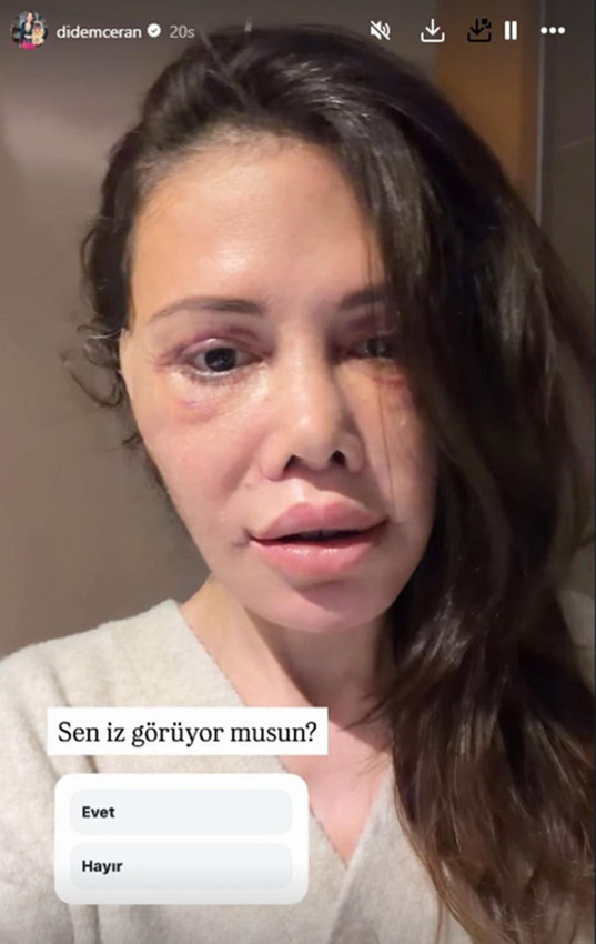 Yüz nakli olan Didem Ceran son halini paylaştı: ''Bebeksiliğim yapay zeka değil'' - Resim: 4