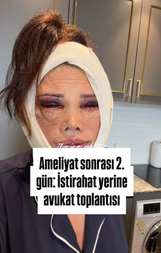 Yüz değiştirme ameliyatı olan eski Survivor yarışmacısından şoke eden iddialar - Resim: 3