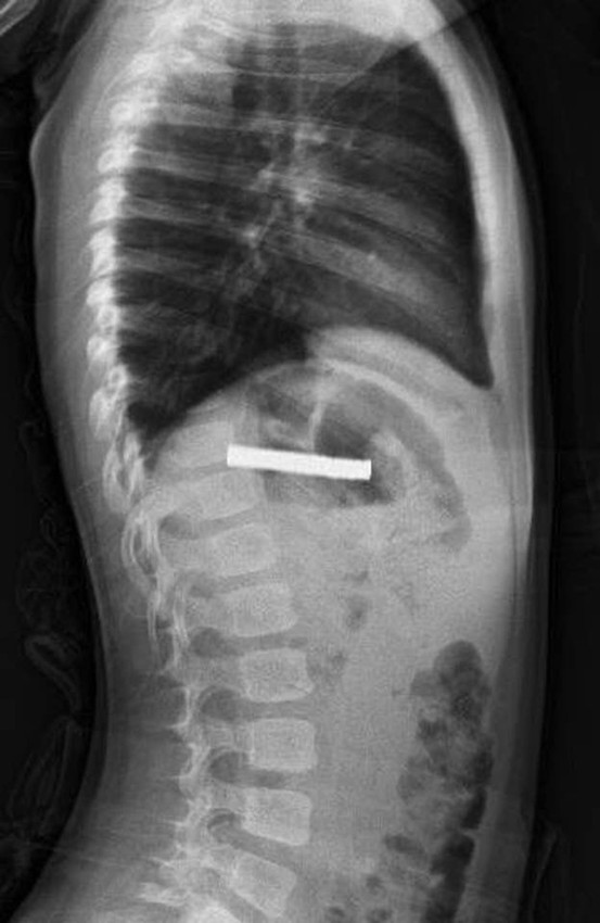 Üç yaşındaki yaramazın boğazından çıkanlar doktorları şoke etti - Resim: 2