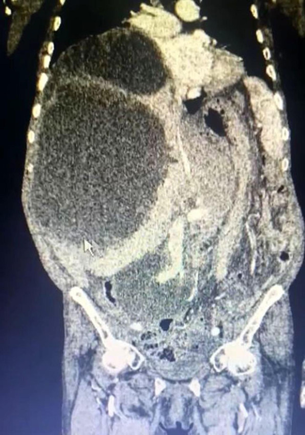 Yaşlı kadının karnından 1 metreye yakın kedi-köpek kisti çıkarıldı - Resim: 2