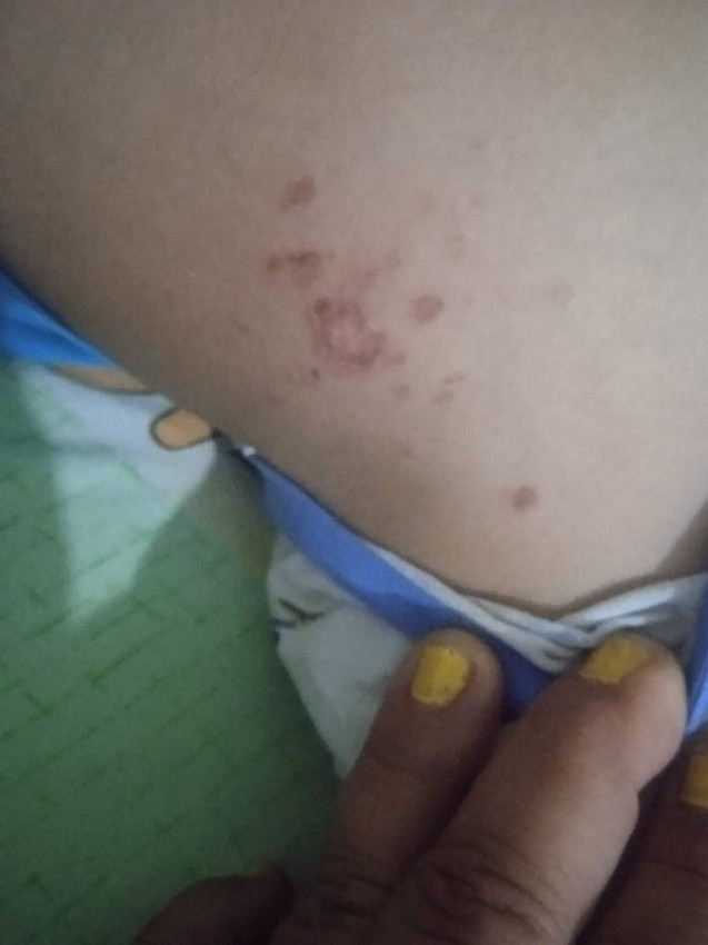 Antalya'da deniz enfeksiyonu alarmı: Denize giren çocuğun vücudu lekelerle kaplandı - Resim: 2
