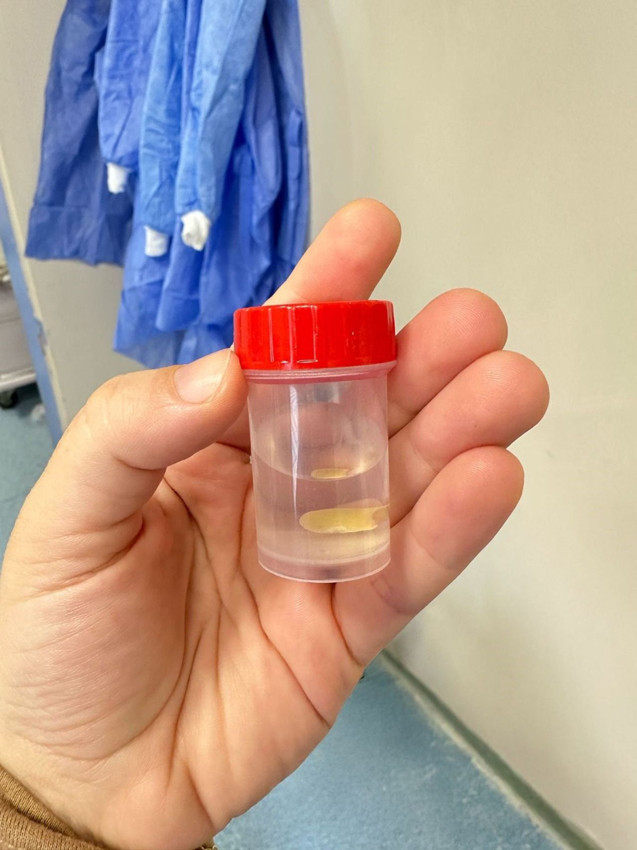 Yemek yerken boğazına kaçtığı farketmedi, gerçeği tam 5 ay sonra hastanede öğrendi - Resim: 4