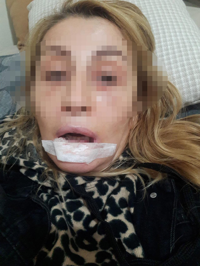 Bir estetik faciası daha: 3 çocuk annesi kadın dudağını kaybetti - Resim: 3