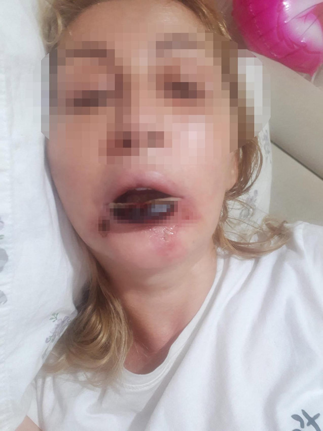 Bir estetik faciası daha: 3 çocuk annesi kadın dudağını kaybetti - Resim: 4