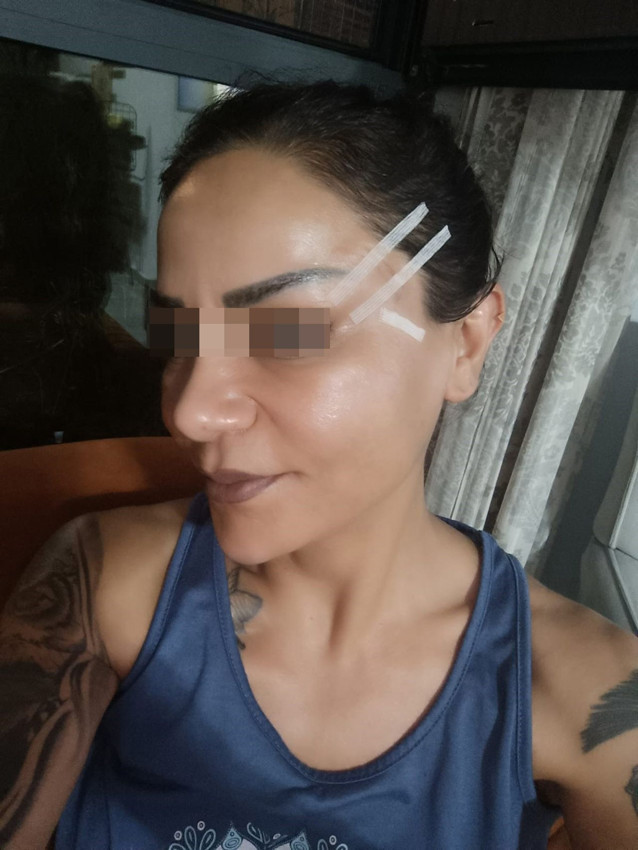 Bir estetik mağduru daha... Hem 200 bin TL'sinden oldu hem de... - Resim: 1