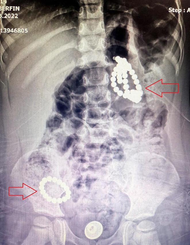 Minik Berfin'in karnından çıkanlar doktorları bile şoke etti - Resim: 2