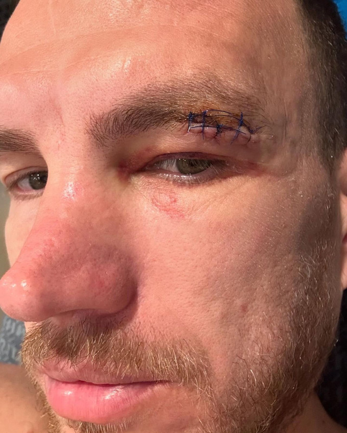 Fenerbahçe'ye kötü haber: Dzeko'nun burnu kırıldı - Resim: 4
