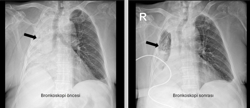 Yemek yerken boğazına kaçtığı farketmedi, gerçeği tam 5 ay sonra hastanede öğrendi - Resim: 2