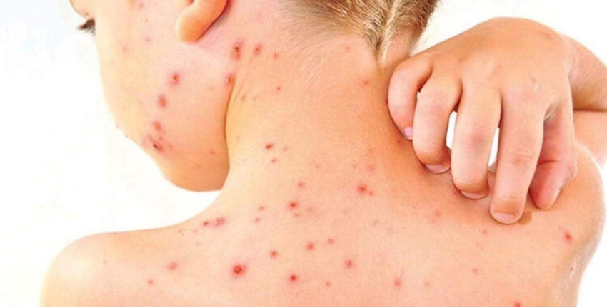 DSÖ'nün ''alarm'' verdiği kızamık salgınında vaka sayısı hızla artıyor - Resim: 2