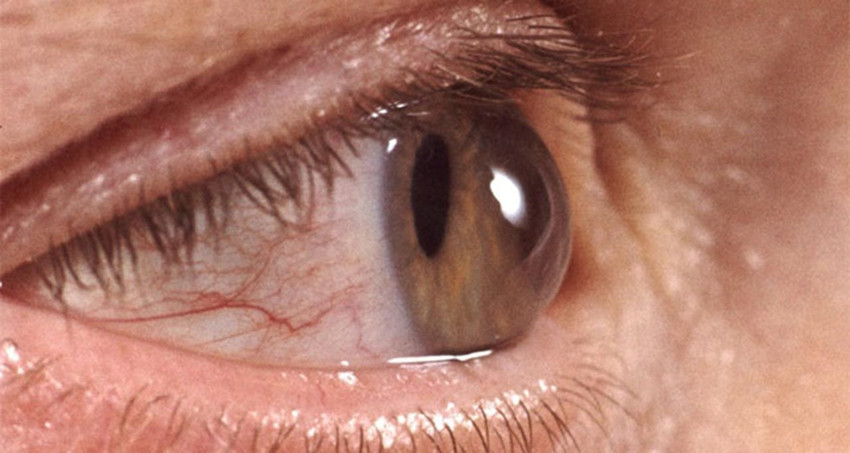 Belirti göstermeyen bu hastalığa dikkat: 2040'a kadar 111 milyon kişiyi etkileyecek - Resim: 3