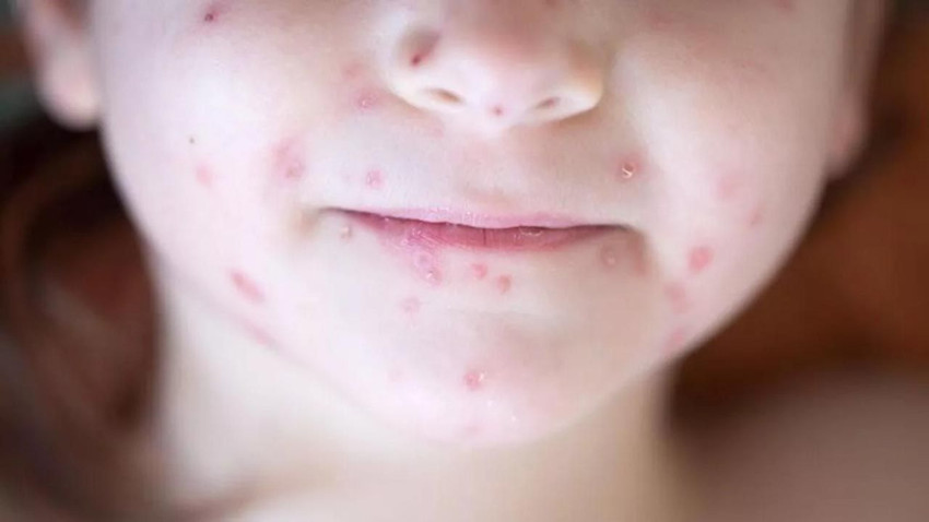 DSÖ'nün ''alarm'' verdiği kızamık salgınında vaka sayısı hızla artıyor - Resim: 1