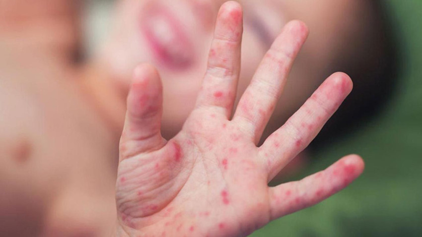 DSÖ'nün ''alarm'' verdiği kızamık salgınında vaka sayısı hızla artıyor - Resim: 4