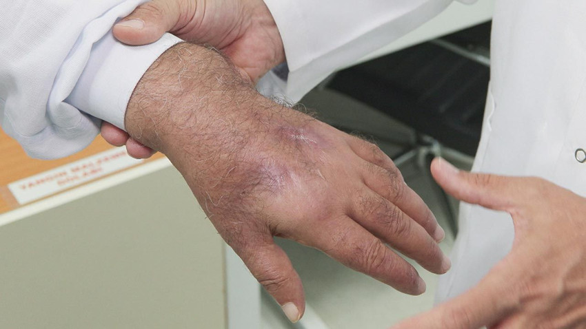 Tıp literatürüne girecek olay! Hırsız elini ısırdı, az kalsın kolunu kaybediyordu - Resim: 3