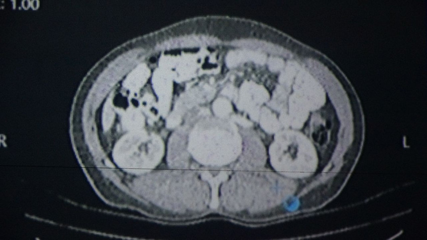 Türk bilim insanlarının yapay zeka ile kanser tedavisi planlaması ilk testi geçti - Resim: 2