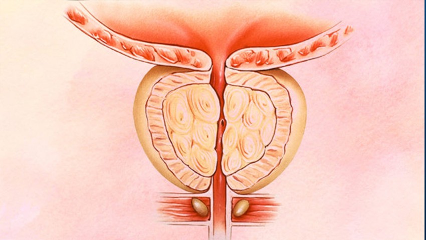 Prostatit (Prostat İltihabı) Belirtileri