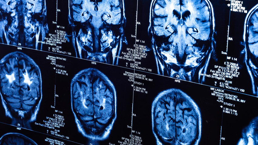 Covid-19 pandemisinin gizli etkisi 5 yıl sonra ortaya çıktı