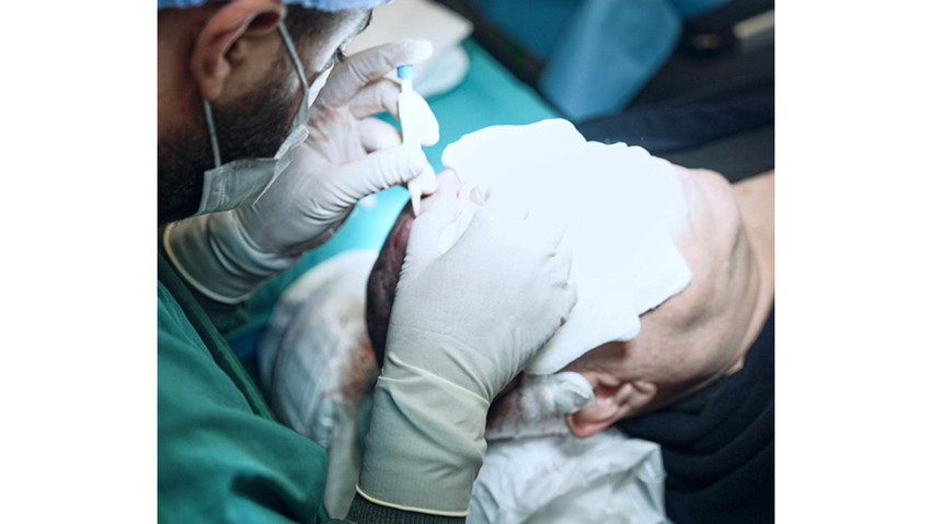 Saç Ekiminde Greft Sayısı Neden Önemlidir?