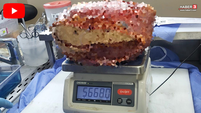 Bacağı git gide şişmeye başlayan hastanın vücudundan çıkan 5,6 kiloluk kitle şoke etti!