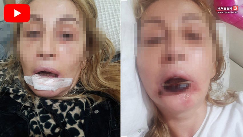 Bir estetik faciası daha: 3 çocuk annesi kadın bu hale geldi!