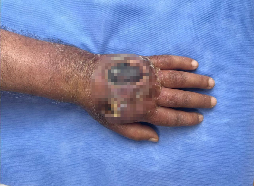 Tıp literatürüne girecek olay! Hırsız elini ısırdı, az kalsın kolunu kaybediyordu - Resim: 1